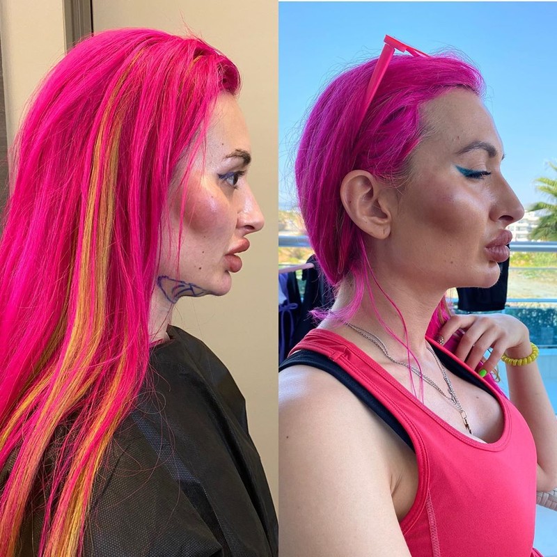 Model Instagram dengan 'Pipi Paling Besar di Dunia'.