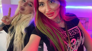 Anastasia tak cuma melakukan filler pada pipi namun juga untuk pipi dan pojok bibirnya. Foto: Instagram/@_just__queen_