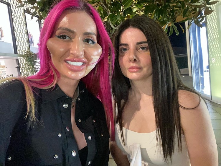Model Instagram dengan Pipi Paling Besar di Dunia.