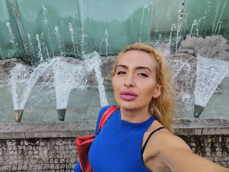 Model Instagram dengan 'Pipi Paling Besar di Dunia'.