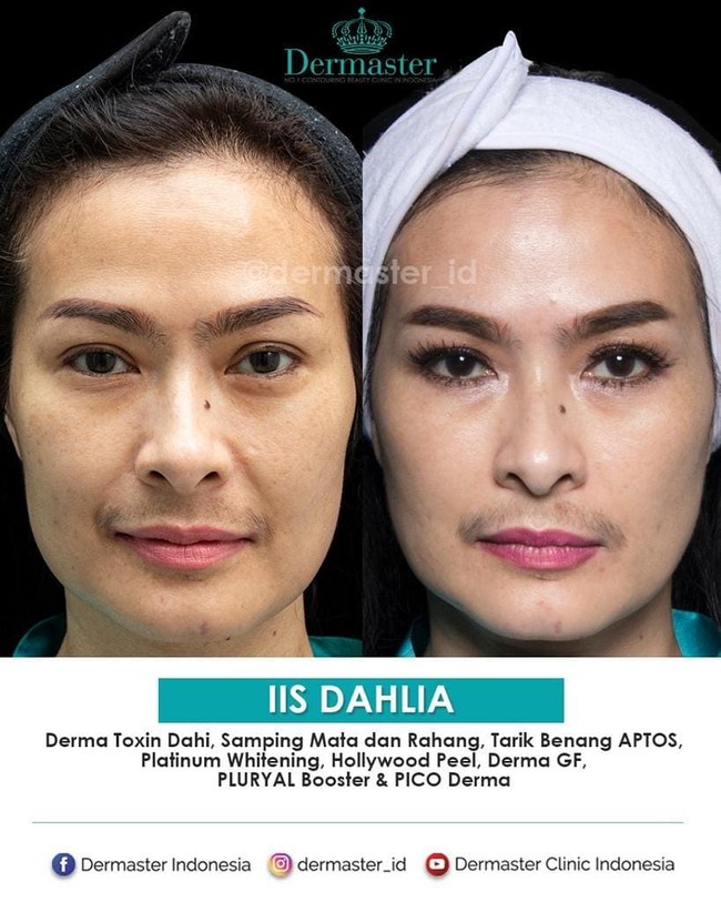 Iis Dahlia terkenal rajin melakukan perawatan kecantikan. Pedangdut ini pun melakukan tarik benang untuk mendapatkan wajah yang lebih kencang dan tirus.  Foto: Instagram @dermaster_id