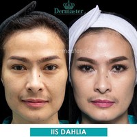 Iis Dahlia terkenal rajin melakukan perawatan kecantikan. Pedangdut ini pun melakukan tarik benang untuk mendapatkan wajah yang lebih kencang dan tirus.  Foto: Instagram @dermaster_id
