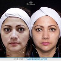 Banyak yang masih belum mengetahui perbedaan tanam benang dan tarik benang. Tarik benang diklaim memberikan hasil yang lebih kencang di wajah. Tarik benang disebut-sebut sebagai metode yang dapat meniruskan wajah. Terlihat pada penampilan Cut Keke ini. Wajahnya setelah melakukan metode tarik benang tampak lebih tirus. Foto: Instagram @dermaster_id