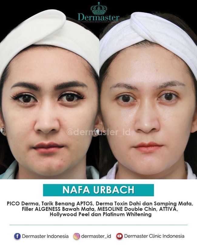 Salah satu klinik kecantikan yang menyediakan prosedur kecantikan tarik benang adalah Dermaster. Nafa Urbach melakukan tarik benang di klinik kecantikan tersebut. Tampak perubahan wajahnya setelah melakukan tarik benang.  Foto: Instagram @dermaster_id