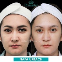 Salah satu klinik kecantikan yang menyediakan prosedur kecantikan tarik benang adalah Dermaster. Nafa Urbach melakukan tarik benang di klinik kecantikan tersebut. Tampak perubahan wajahnya setelah melakukan tarik benang.  Foto: Instagram @dermaster_id