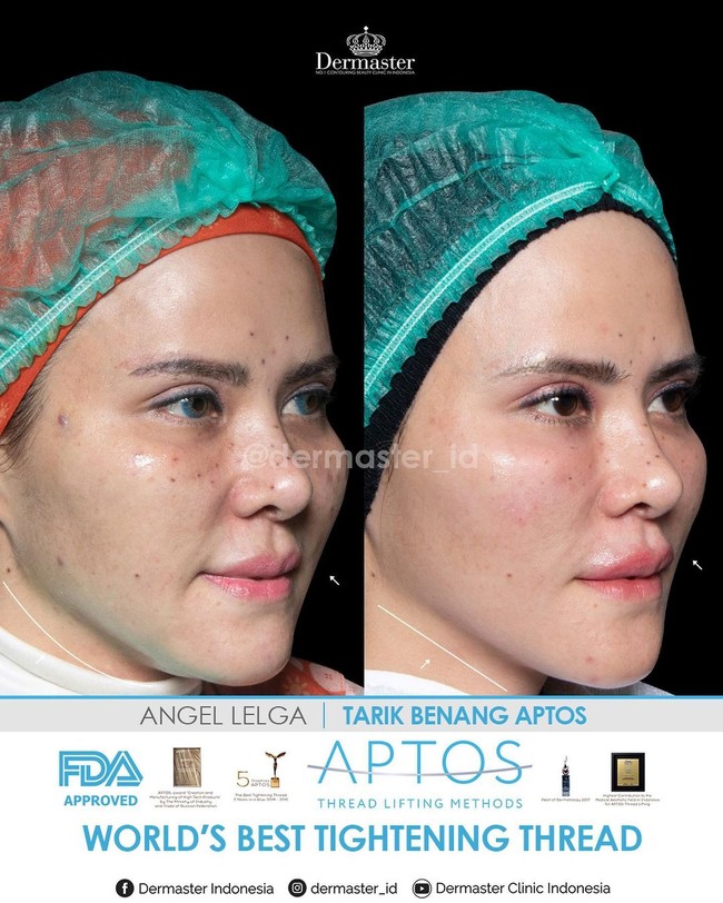 Prosedur kecantikan tarik benang semakin banyak diminati. Terlebih setelah banyak artis Indonesia yang melakukan perawatan tersebut. Hasilnya pun terlihat nyata perbedaannya. Ada Angel Lelga yang melakukan tarik benang. Dari foto before afternya tampak wajah Angel lebih kencang dan smiling line memudar.  Foto: Instagram @dermaster_id
