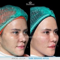 Prosedur kecantikan tarik benang semakin banyak diminati. Terlebih setelah banyak artis Indonesia yang melakukan perawatan tersebut. Hasilnya pun terlihat nyata perbedaannya. Ada Angel Lelga yang melakukan tarik benang. Dari foto before afternya tampak wajah Angel lebih kencang dan smiling line memudar.  Foto: Instagram @dermaster_id
