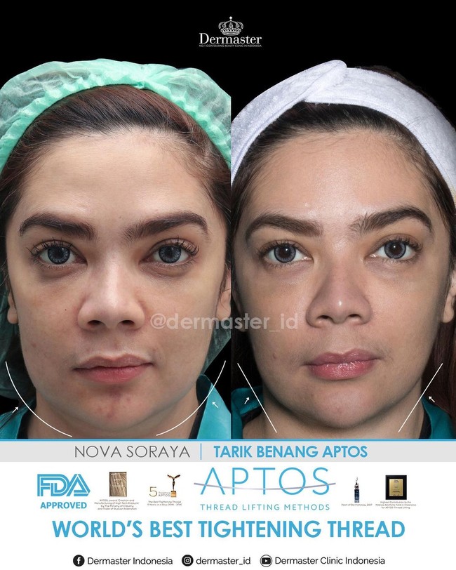 Tarik benang menggunakan tipe benang bergigi. Tujuannya untuk menarik kulit kendur ke arah atas sehingga bagian tersebut akan terlihat lebih tirus. Inilah penampilan pesinetron Nova Soraya sebelum dan setelah tarik benang. Foto: Instagram @dermaster_id