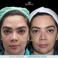 Tarik benang menggunakan tipe benang bergigi. Tujuannya untuk menarik kulit kendur ke arah atas sehingga bagian tersebut akan terlihat lebih tirus. Inilah penampilan pesinetron Nova Soraya sebelum dan setelah tarik benang. Foto: Instagram @dermaster_id
