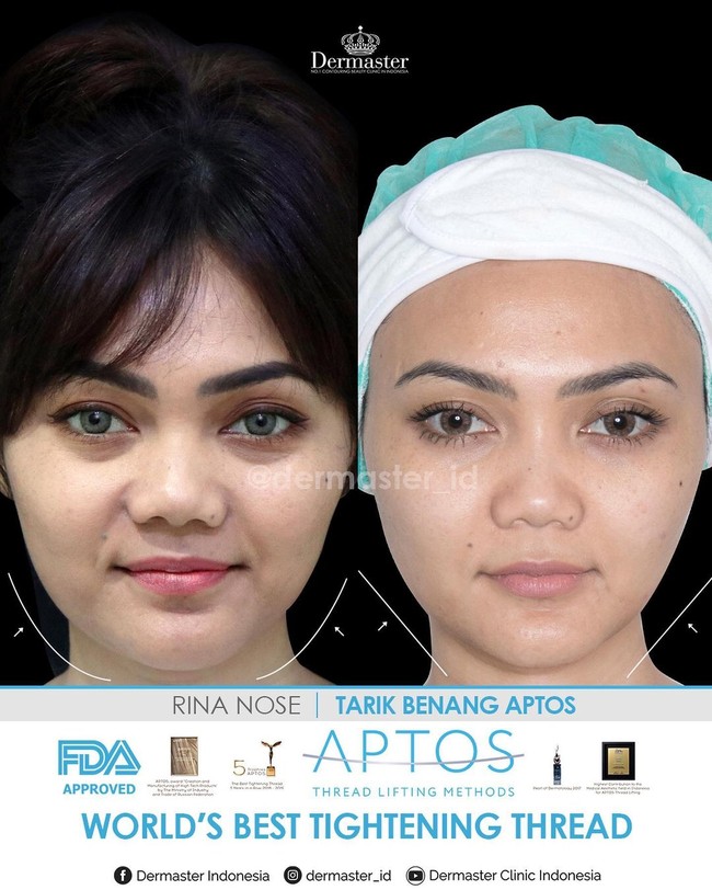 Klinik Dermaster mengklaim dengan perawatan tarik benang membuat wajah tampak lebih muda 10 tahun. Rina Nose juga melakukan prosedur tarik benang yang membuat wajahnya tampak lebih kencang, tirus dan garis bibir memudar.  Foto: Instagram @dermaster_id