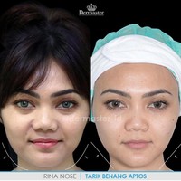 Klinik Dermaster mengklaim dengan perawatan tarik benang membuat wajah tampak lebih muda 10 tahun. Rina Nose juga melakukan prosedur tarik benang yang membuat wajahnya tampak lebih kencang, tirus dan garis bibir memudar.  Foto: Instagram @dermaster_id
