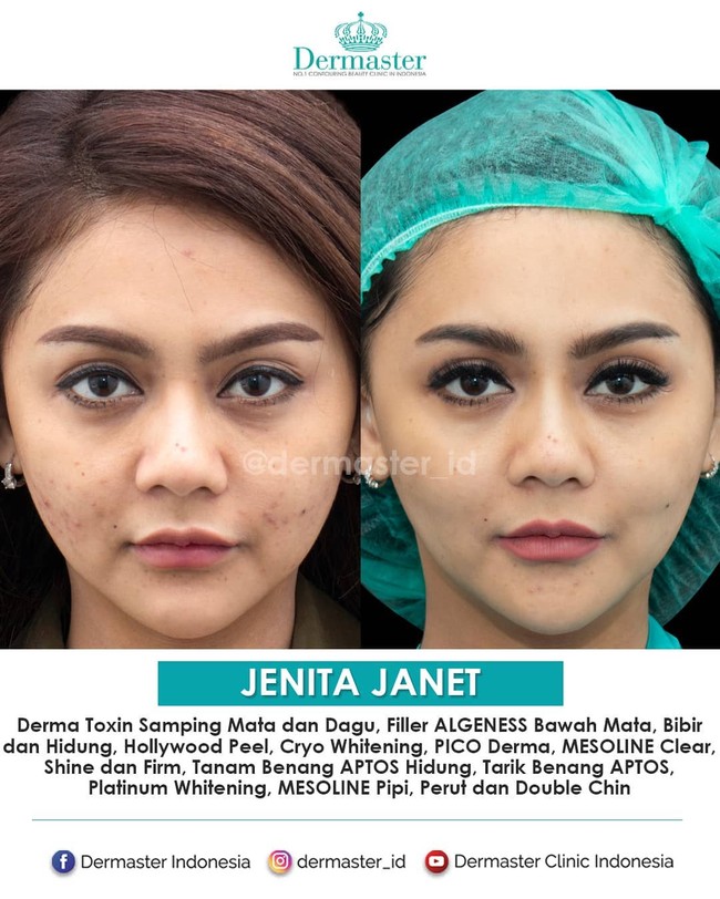 Jenita Janet juga kerap melakukan beragam perawatan kecantikan. Tarik benang pun pernah dilakukannya. Tampak perubahan wajahnya sebelum dan sesuadah perawatan.  Foto: Instagram @dermaster_id