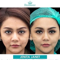 Jenita Janet juga kerap melakukan beragam perawatan kecantikan. Tarik benang pun pernah dilakukannya. Tampak perubahan wajahnya sebelum dan sesuadah perawatan.  Foto: Instagram @dermaster_id