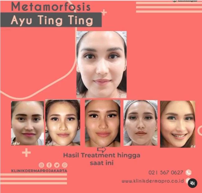 Sebelum ada prosedur tarik benang, metode kecantikan tanam benang pun populer. Lesty Kejora misalnya yang melakukan perawatan tanam benang.  Foto: Instagram klinikdermaprojakarta