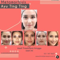 Sebelum ada prosedur tarik benang, metode kecantikan tanam benang pun populer. Lesty Kejora misalnya yang melakukan perawatan tanam benang.  Foto: Instagram klinikdermaprojakarta