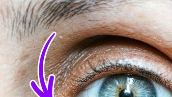 Karankula lakrimalis atau Caruncle lakrimal adalah bagian bulat kecil berwarna pink di sudut dalam (kantus medial) mata, terdiri dari kulit yang menutupi kelenjar sebaceous dan keringat. Foto: Istimewa/BrightSide
