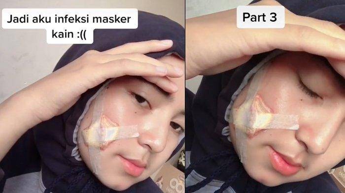 viral TikTok Wanita berjerawat hingga dioperasi karena masker kain.