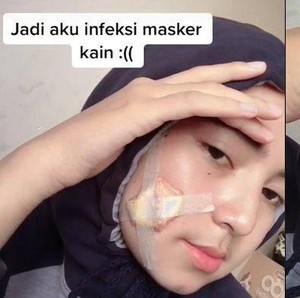 Viral Kisah Wanita Berjerawat Karena Masker Kain, Akhirnya Sampai Dioperasi Viral Kisah Wanita Berjerawat Karena Masker Kain, Akhirnya Sampai Dioperasi
