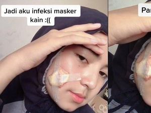 Viral Kisah Wanita Berjerawat Karena Masker Kain, Akhirnya Sampai Dioperasi