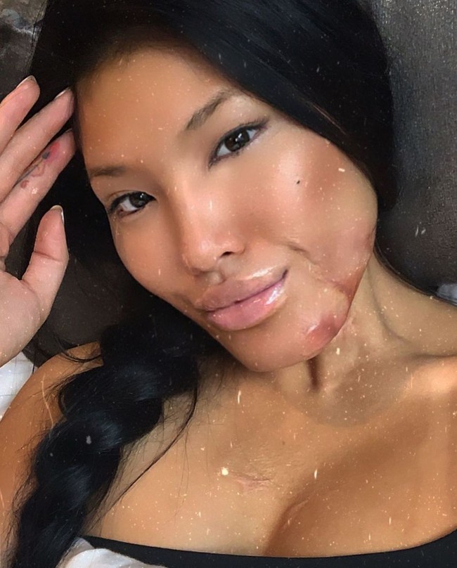 Dan seperti inilah penampilan Sophie kini. Meski ada bekas luka yang terlihat jelas, terlebih di area dadanya, namun Sophie tetap percaya diri. Foto: dok. Instagram @sophirelee