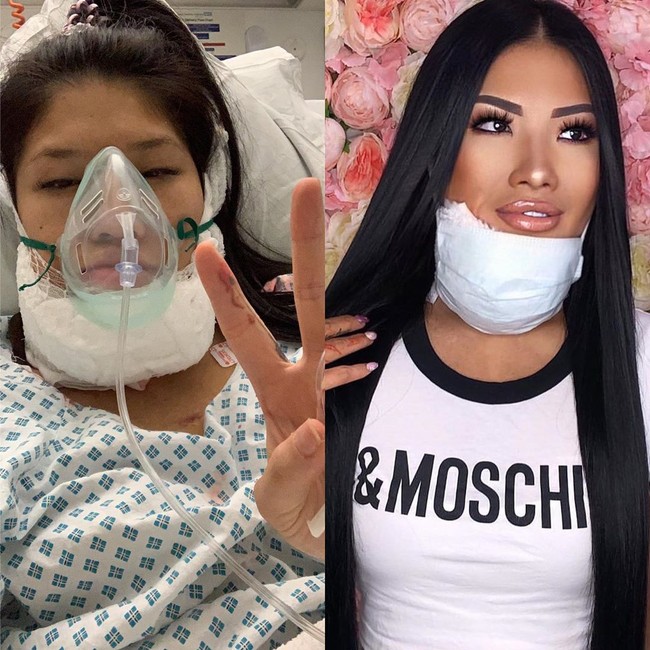 Untuk menghilangkan lukanya, Sophie masih harus melakukan berbagai operasi plastik. Tak jarang ia memamerkan foto rahangnya dengan perban di Instagramnya.  Foto: dok. Instagram @sophirelee