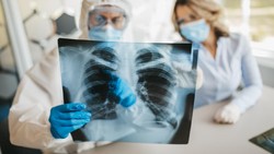 Ilmuwan Teliti Jenazah Pasien COVID-19, Ini yang Ditemukan di Paru-paru