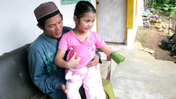 Bocah perempuan di Sukabumi  butuh tangan palsu