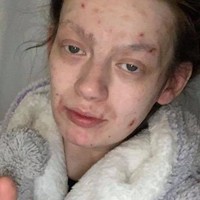 Demi mengaku dulu hampir setiap hari menggunakan narkoba jenis heroin dan kokain. Hal tersebut merusak tubuhnya yang kemudian jadi kurus dan ditumbuhi jerawat dan korengan. Foto: Facebook Demi-Nicole Dunlop