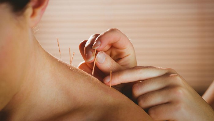 Akupuntur Young woman getting acupuncture treatment in therapy room