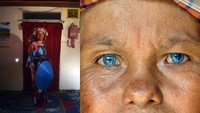 Fitri Yenti (45) berpose di rumahnya, di Jorong Batu Lipai, Nagari Batipuah Baruah, Kecamatan Batipuah, Kabupaten Tanah Datar, Sumatera Barat. Mereka adalah orang-orang yang memiliki sindrom Waardenburg, sindrom langka yang menyebabkan gangguan pendengaran, perubahan warna mata, kulit, rambut, dan bentuk wajah.