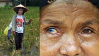 Erma Wanita (60) berpose di Jorong Batu Lipai, Nagari Batipuah Baruah, Kecamatan Batipuah, Kabupaten Tanah Datar, Sumatera Barat. Orang dengan kondisi ini biasanya memiliki iris mata berwarna biru atau berbeda warna (Heterokromia iridium), seperti satu biru dan satu hitam atau coklat. Nama sindrom ini diambil dari nama D.J. Waardenburg, dokter mata asal Belanda yang pertama kali mengidentifikasinnya pada tahun 1951.