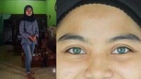 Surya Lestari (25) berpose di rumahnya, di Jorong Bukit Gombak, Nagari Baringin, Kecamatan Lima Kaum, Kabupaten Tanah Datar, Sumatera Barat. Dokter Alana Biggers, lulusan Universitas Illinois Chicago, Amerika Serikat mengatakan, Sindrom Waardenburg adalah kondisi genetik langka, yang hanya diderita oleh 1 dari 40.000 orang di dunia. Orang dengan sindrom ini biasanya mengalami gangguan pendengaran di salah satu maupun di kedua telinganya. Selain itu mereka juga tidak mampu melihat cahaya yang sangat terang, tapi bisa melihat benda meskipun dalam kondisi gelap.
