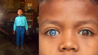 Seperti yang dialami dua anak laki-laki di Jorong Kubang Rasau, Nagari Balai Panjang, Kabupaten Limapuluhkota, Sumatera Barat. Fahri (9) dan Gofar (4), keduanya memiliki warna iris mata biru, dan sebelahnya berwarna cokelat. Mata biru mereka indah seperti berlian, tapi mereka mengalami gangguan pendengaran sejak lahir.