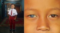 Hal serupa dialami oleh Dani (6,5) dan adiknya, Alika (2,5), warga Jorong Padang Data, Nagari Simawang, Kecamatan Rambatan, Kabupaten Tanah Datar, Sumatera Barat. Mereka berdua memiliki mata biru tapi mengalami gangguan pendengaran sejak lahir.