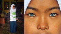 Memiliki iris mata berlainan warna, juga dialami seorang pelajar bernama Armila Putri (14), yang tinggal di Jorong Batu Lipai, Nagari Batipuah Baruah, Kecamatan Batipuah, Kabupaten Tanah Datar. Meskipun memiliki mata berlainan warna, tidak ada gangguan pendengaran yang dialami Armila, semuanya normal. Armila memiliki iris mata sebelah kiri berwarna biru, dan sebelahnya lagi hitam, membuat dirinya diolok-olok sejak duduk di bangku sekolah dasar.