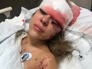 Kecelakaan Sampai Berdarah-darah, Wanita Ini Malah Review Eyelash Extension