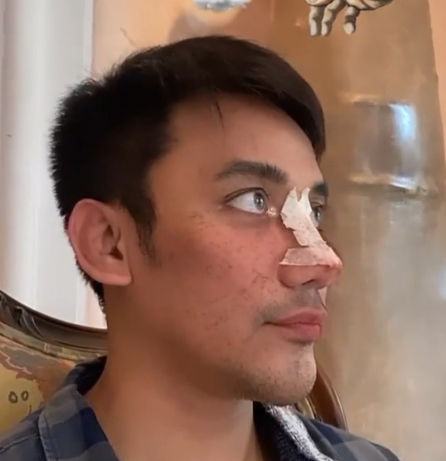 Tak hanya rhinoplasty atau operasi plastik hidung, namun Bubah juga melakukan implan dagu.  Foto: dok. Instagram