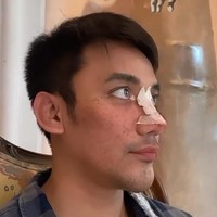 Tak hanya rhinoplasty atau operasi plastik hidung, namun Bubah juga melakukan implan dagu.  Foto: dok. Instagram