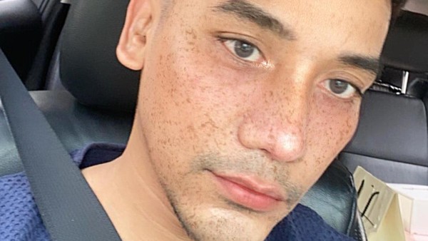 Foto: Penampilan Baru MUA Bubah Alfian Setelah Operasi Plastik Hidung