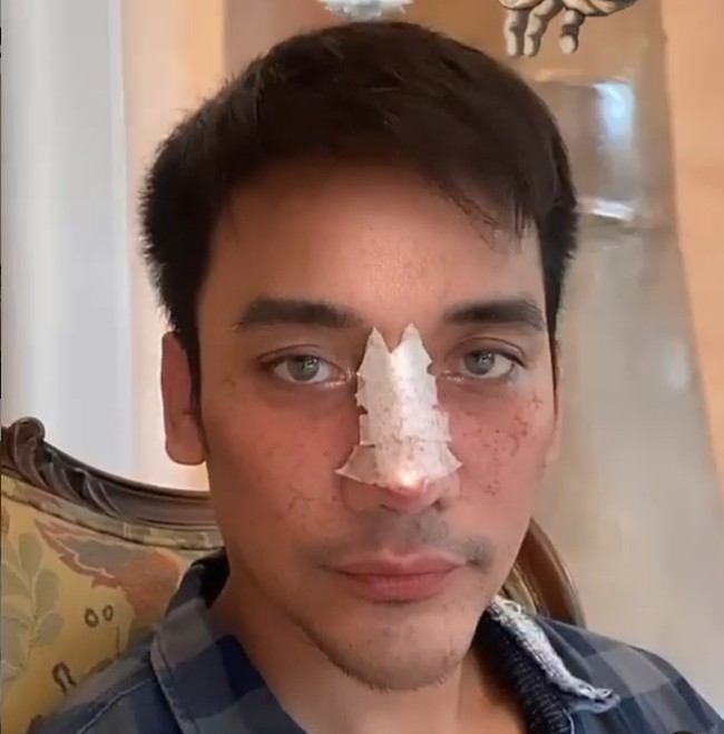 Sebelum memutuskan untuk implan hidung, Bubah Alfian sempat rutin melakukan filler di hidungnya. Namun, ternyata berdampak buruk. Setelah berkonsultasi ke dokter Tompi, tulang hidung pria 33 tahun itu ternyata keropos.  Foto: dok. Instagram
