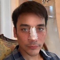 Sebelum memutuskan untuk implan hidung, Bubah Alfian sempat rutin melakukan filler di hidungnya. Namun, ternyata berdampak buruk. Setelah berkonsultasi ke dokter Tompi, tulang hidung pria 33 tahun itu ternyata keropos.  Foto: dok. Instagram