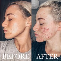 Aku akan jujur, aku sering menangis saat malam, sebagian karena bagaimana penampilanku di cermin. Aku akan terus membandingkan kulitku dengan teman-teman dan orang asing yang berpapasan di jalan ungkapnya dilansir Insider. Foto: Instagram @_jessyoga