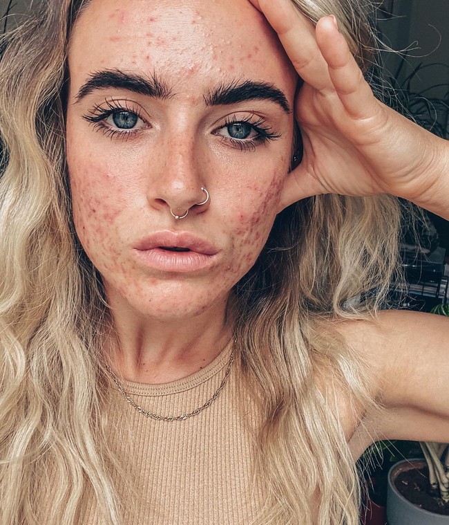 Tanpa makeup, filter, dan pencahayaan yang memanipulasi keadaan kulit, Jess menampilkan wajahnya yang sedang bermasalah. Ia pun memberanikan diri untuk mengungkap kondisi kulit asli untuk mendukung sesama pejuang jerawat. Foto: Instagram @_jessyoga