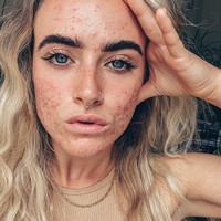 Tanpa makeup, filter, dan pencahayaan yang memanipulasi keadaan kulit, Jess menampilkan wajahnya yang sedang bermasalah. Ia pun memberanikan diri untuk mengungkap kondisi kulit asli untuk mendukung sesama pejuang jerawat. Foto: Instagram @_jessyoga