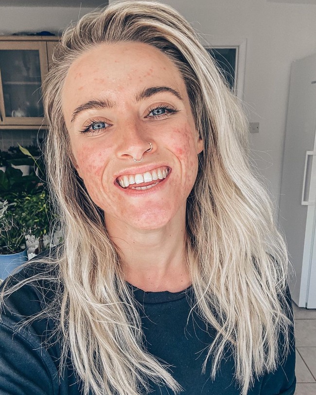 Dalam postingannya, Jess Mackenzien menambahkan tanda pagar #acnepositivity untuk memulai tren dengan harapan menormalisasi kulit berjerawat. Bisa menampilkan diri sendiri, ia merasa menemukan kehidupan Instagram yang baru. Foto: Instagram @_jessyoga