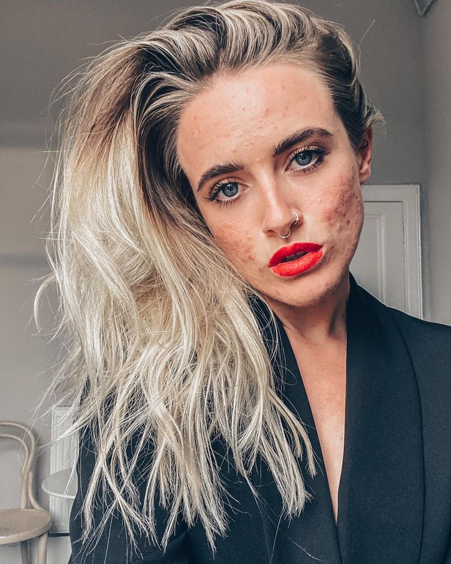 Jess mulai berjerawat sejak remaja yang keadaan semakin parah ketika dewasa. Wanita itu lalu didiagnosa menderita jerawat sistik parah. Diakuinya ia tentu tidak percaya diri dengan kondisi wjaah hingga membuatnya menangis. Foto: Instagram @_jessyoga