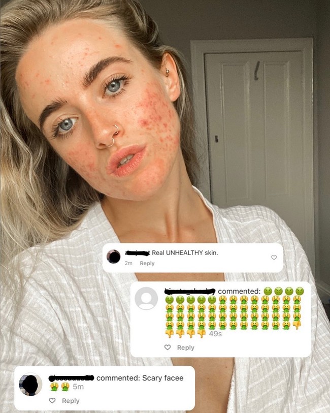 Meski tahu akan mendapat respon yang tidak semua positif dari situ Jess merasa itu lah saatnya untuk keluar dari sisi gelap edit Instagram. Jalanku untuk benar-benar terkoneksi dengan komunitas positif jerawat. Jadi aku klik unggah dan langsung keluar dari kegelapan menuju chaya penerimaan diri, tuturnya lagi. Foto: Instagram @_jessyoga.