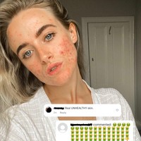 Meski tahu akan mendapat respon yang tidak semua positif dari situ Jess merasa itu lah saatnya untuk keluar dari sisi gelap edit Instagram. Jalanku untuk benar-benar terkoneksi dengan komunitas positif jerawat. Jadi aku klik unggah dan langsung keluar dari kegelapan menuju chaya penerimaan diri, tuturnya lagi. Foto: Instagram @_jessyoga.