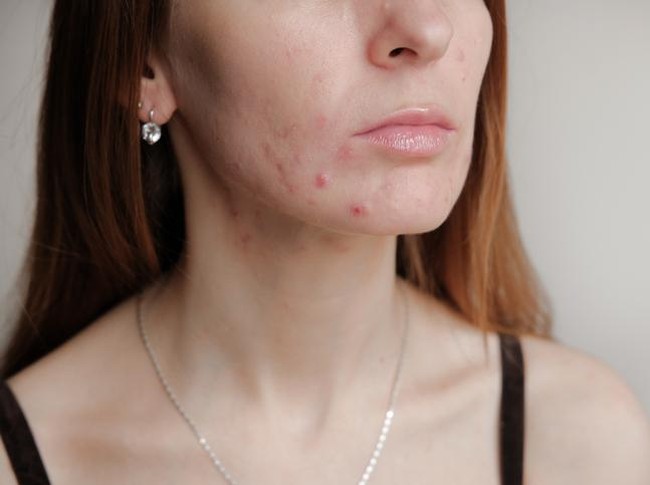 Kopi dapat Picu Jerawat