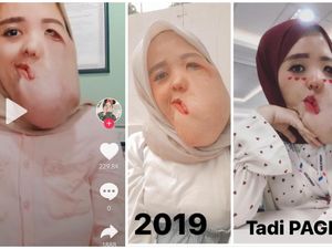 Viral Idap Tumor hingga Wajah Bengkak, Pesan Anti Insecure-nya Bikin Terenyuh